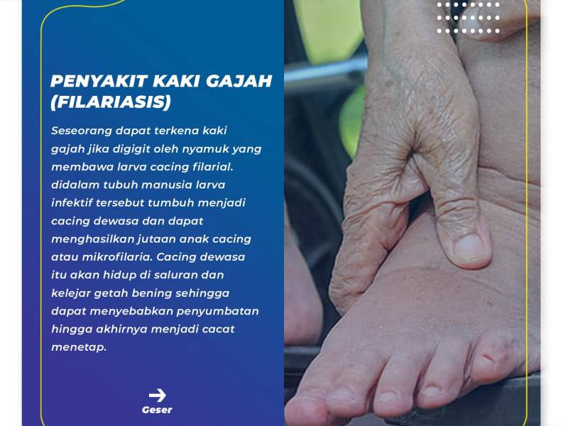 Penyakit Kaki Gajah (Filariasis)